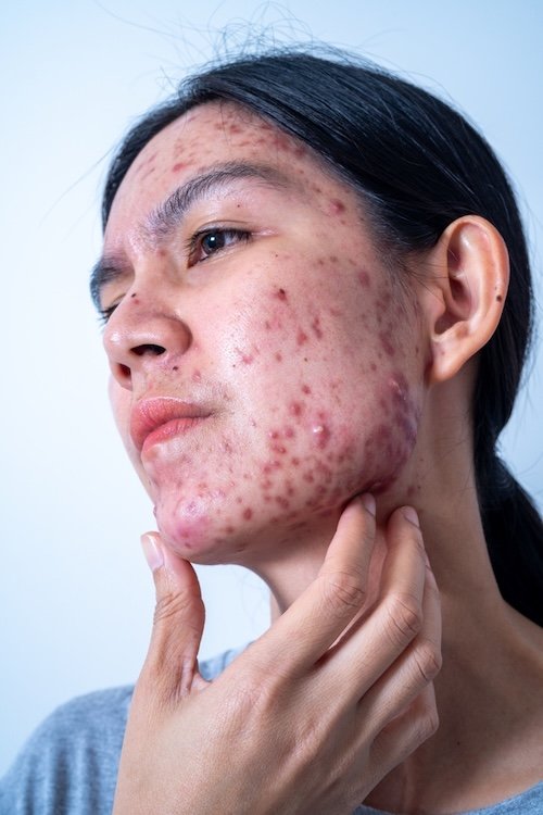 acne scar treatment in thane