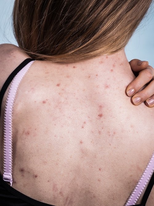back acne treatment in thane