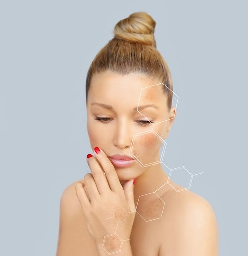 melasma treatment in thane