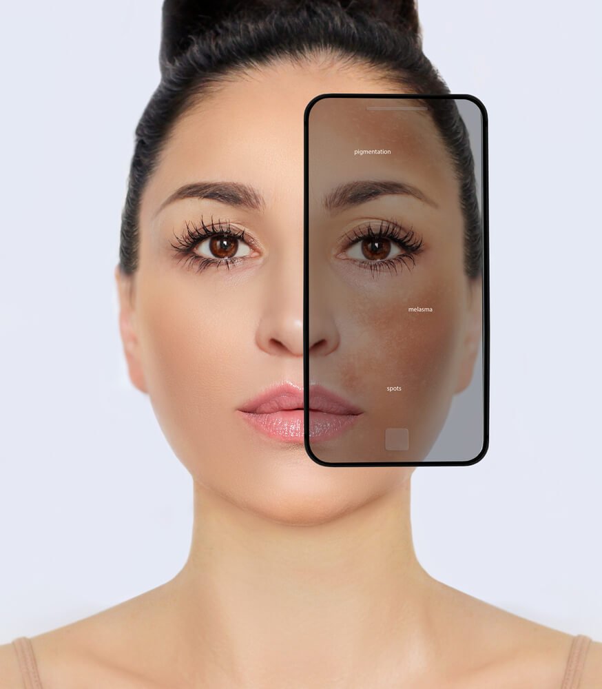 Melasma Laser Treatment in Thane