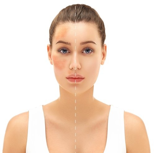 pigmentation treatment in thane